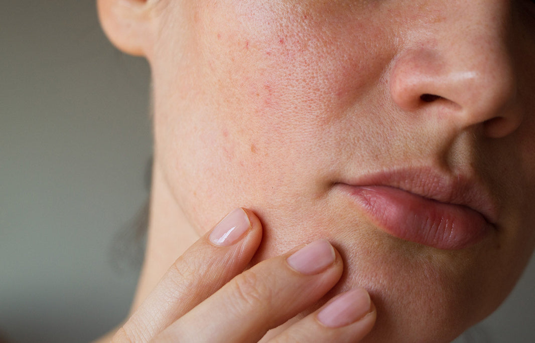 What is Rosacea?
