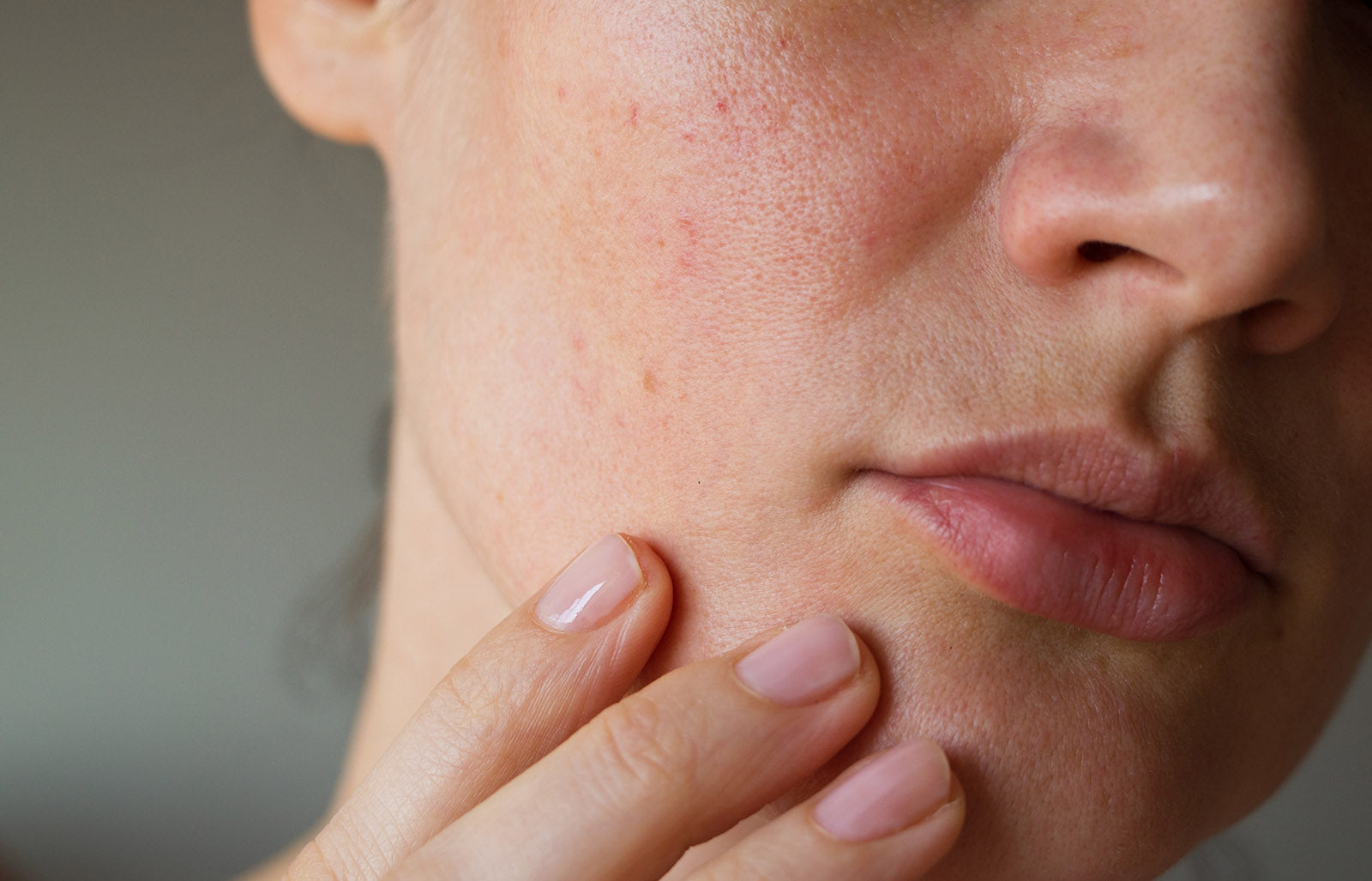 What is Rosacea?
