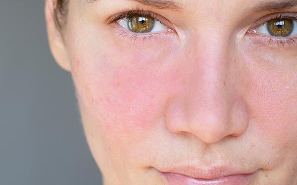 Essential Read for Skin Care Therapists:  Unlocking the Secrets to Effectively Managing Rosacea in Your Clients