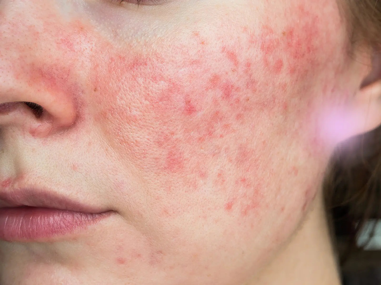 From Red Flags to Radiance: Halting Couperose Before It Becomes Rosacea