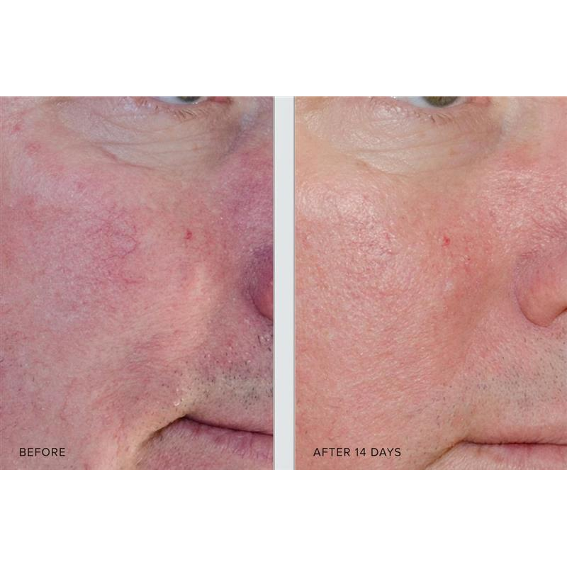 Before and after 14 days image showing visible improvement in redness and skin texture after using Pevonia RS2 Rosacea Care Cream
