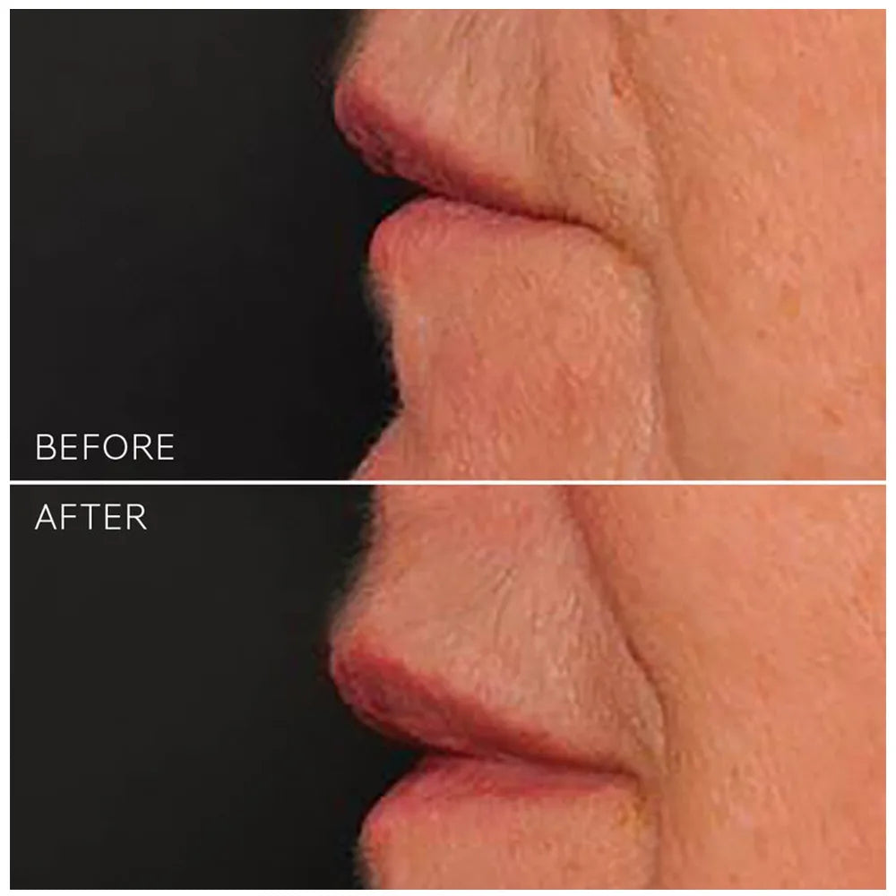 Before and after comparison of a person's lips with visible skin texture.