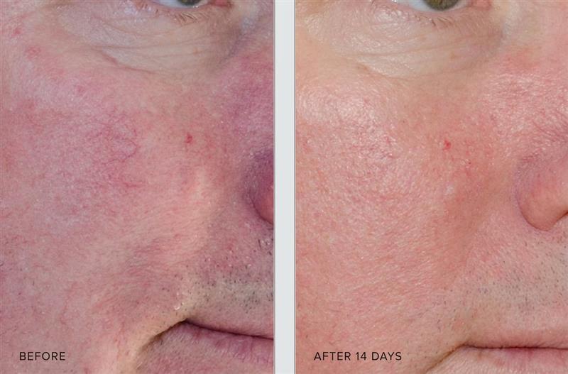 Before and after comparison of a person's face with visible skin conditions on a pink background.