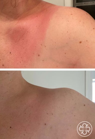 Before and after use of Waterlily comparison of sunburn on a person's shoulder.