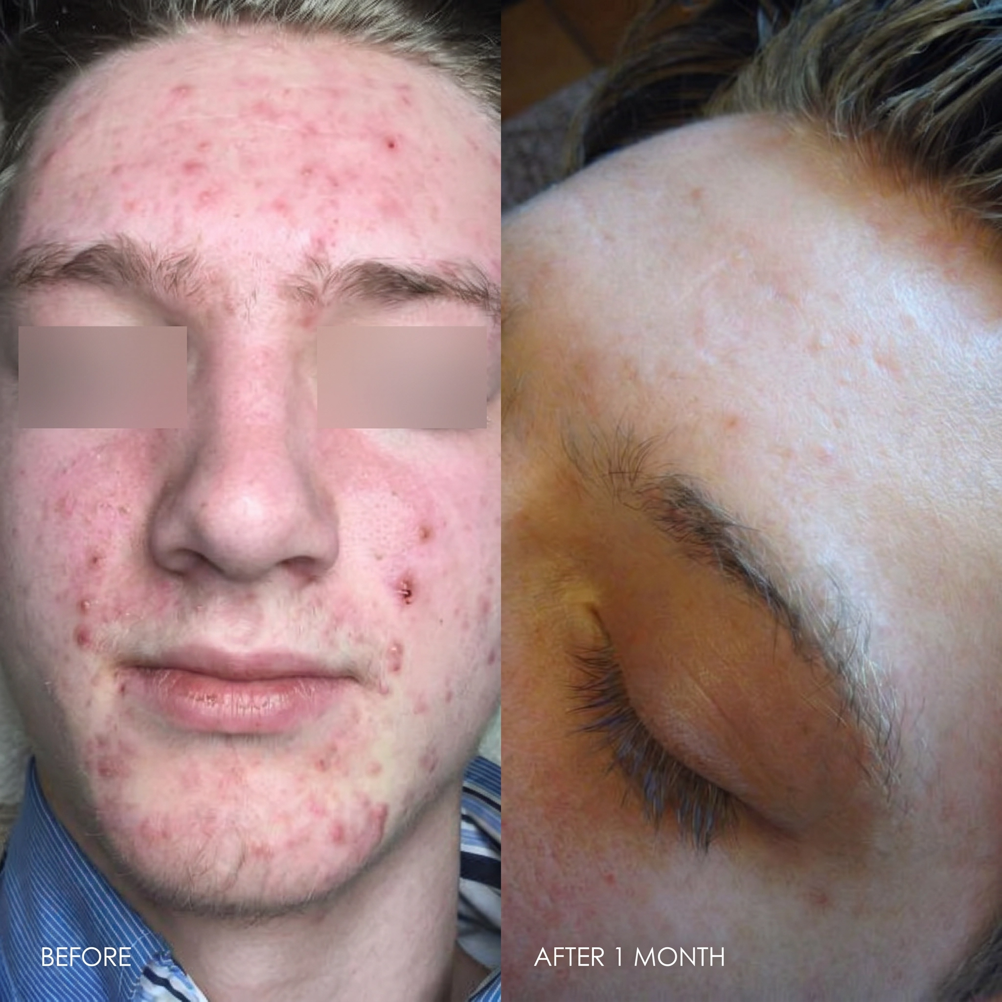 Before and after 1 month acne improvement using Medicalia Zinc & Peptides Peel, showing visibly calmer skin, reduced redness, and fewer active breakouts.