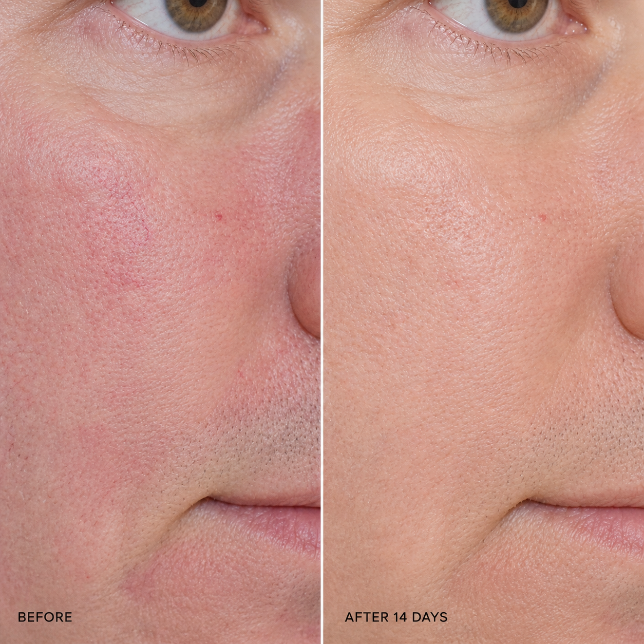 Before and after 14 days image showing visible improvement in redness and skin texture after using Pevonia RS2 Rosacea Care Cream